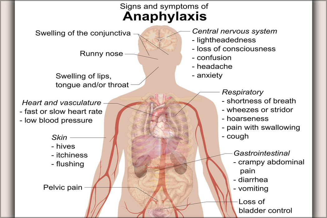 24"x36" Gallery Poster, Allergy Signs and symptoms of anaphylaxis
