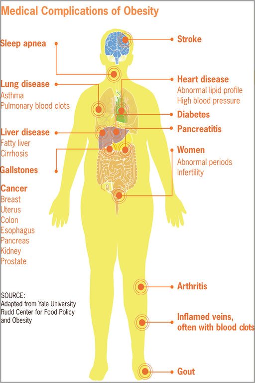 24"x36" Gallery Poster, Medical complications of obesity and being overweight cdc