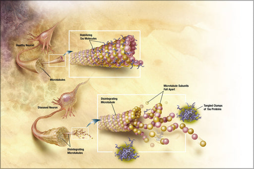 Poster, Many Sizes Available; Diagram Of How Microtubules Desintegrate With Alzheimer&#39;S Disease